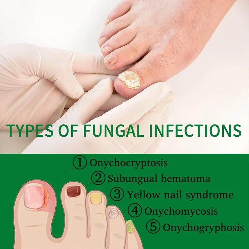 7 Days Nail Fungal Treatment Essence Fungus Removal Serum Repair All Natural Formula