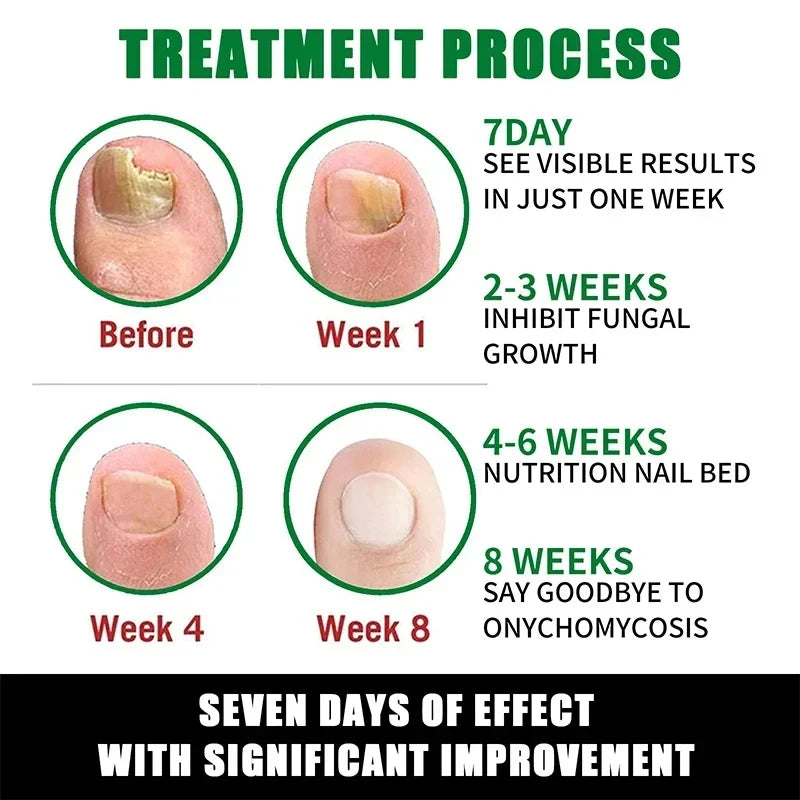 7 Days Nail Fungal Treatment Essence Fungus Removal Serum Repair All Natural Formula