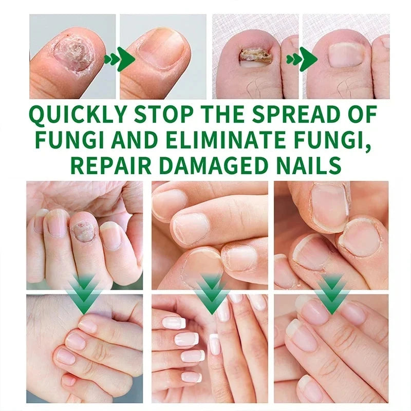 7 Days Nail Fungal Treatment Essence Fungus Removal Serum Repair All Natural Formula